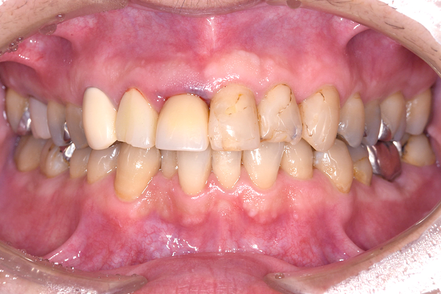 インプラント術前写真