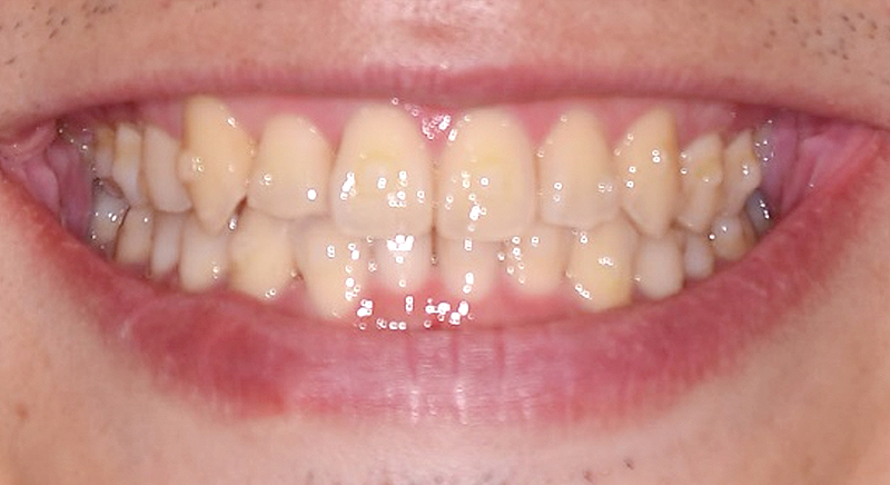 インビザライン術後写真