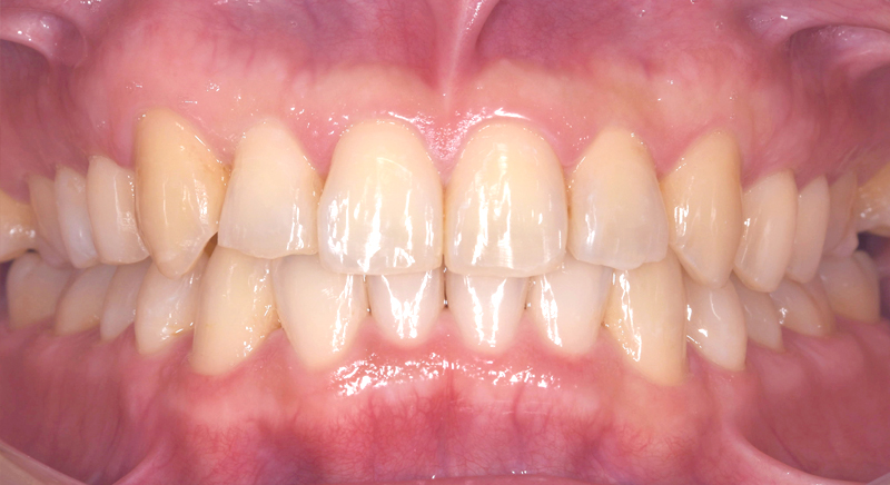 インビザライン術後写真