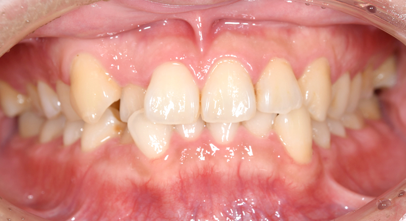 インビザライン術前写真