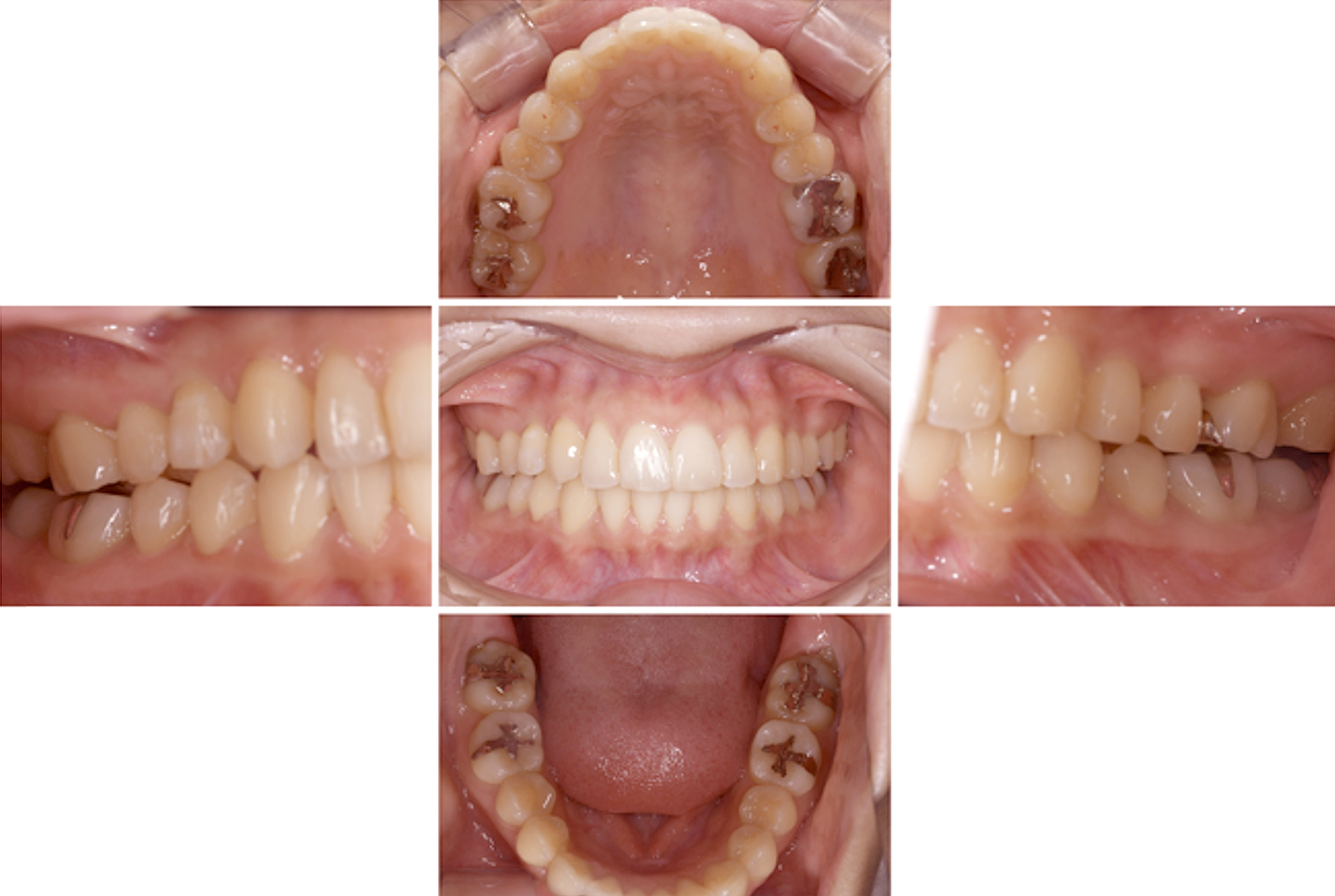 インビザライン術後写真