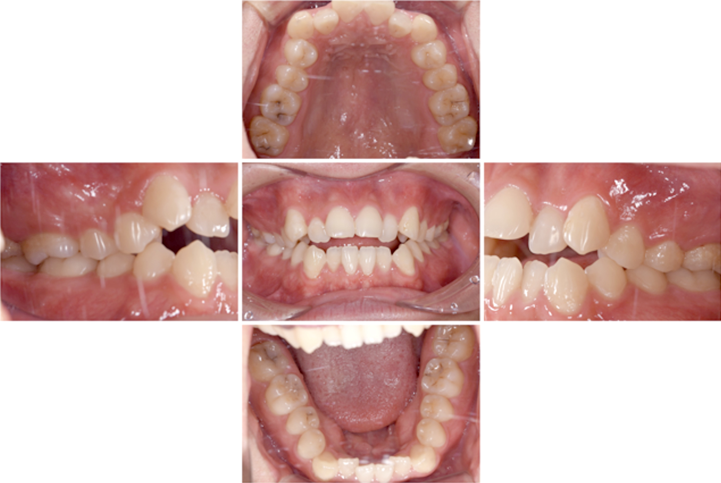 インビザライン術前写真