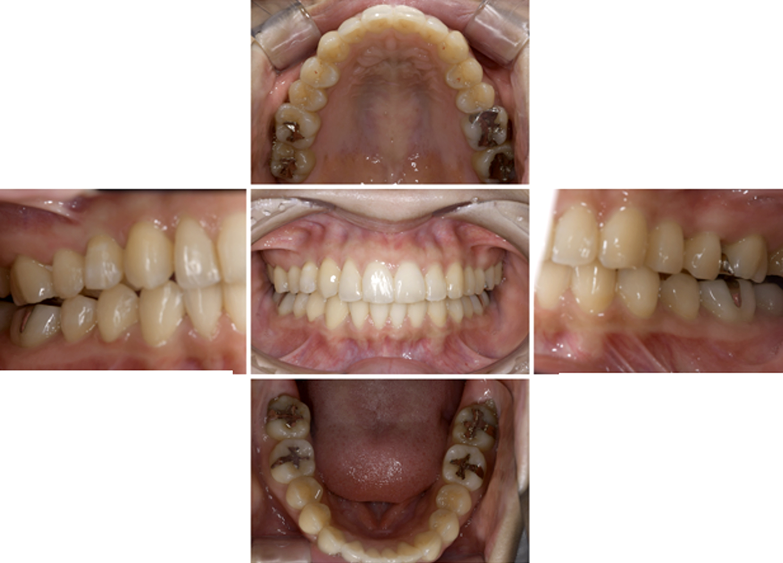 インビザライン術後写真