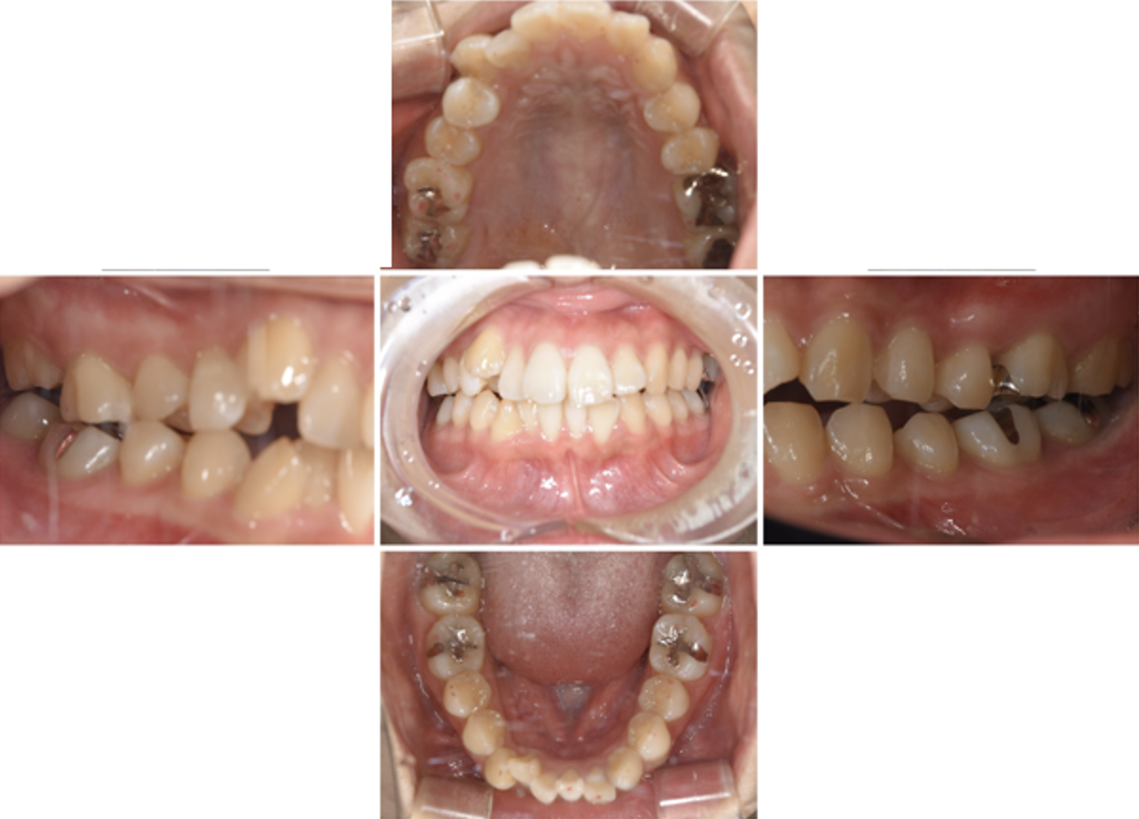 インビザライン術前写真