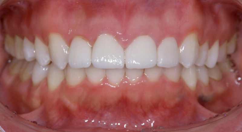 インビザライン術後写真