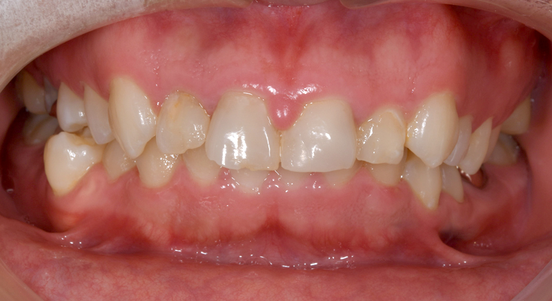 インビザライン術前写真