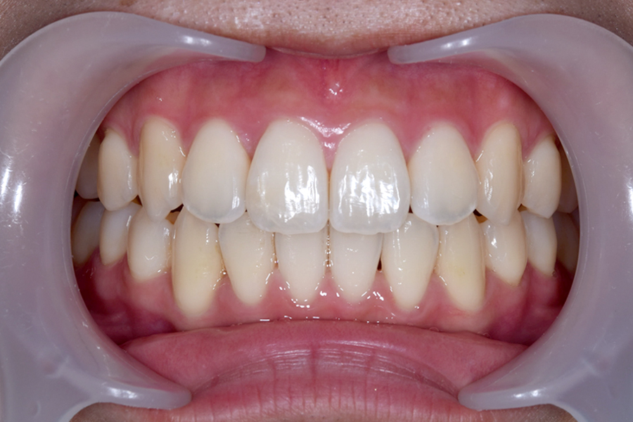 インビザライン術後写真