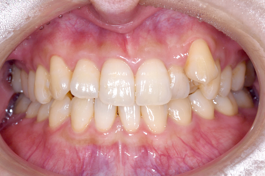 インビザライン術前写真