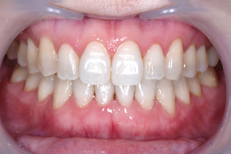 インビザライン術後写真