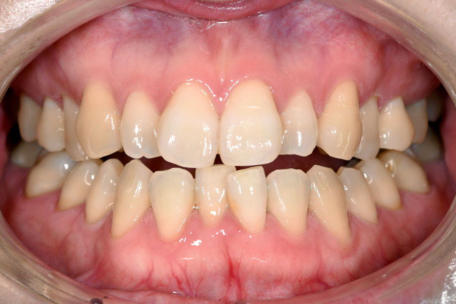 インビザライン術前写真