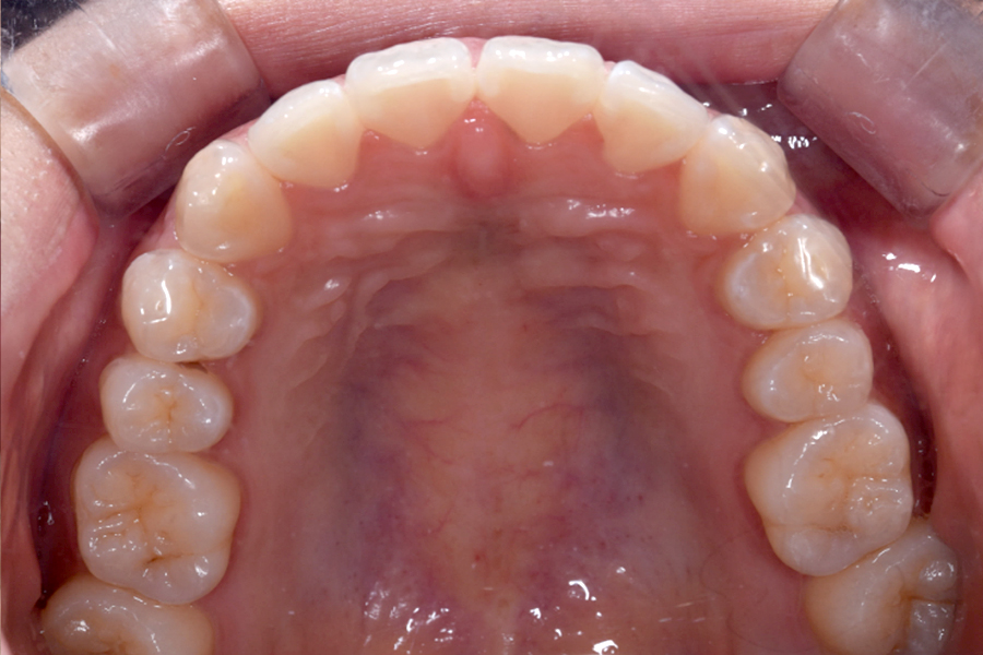 インビザライン術後写真