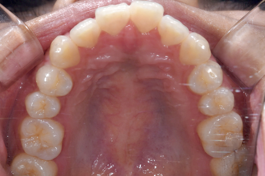 インビザライン術前写真