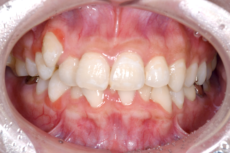 インビザライン術前写真