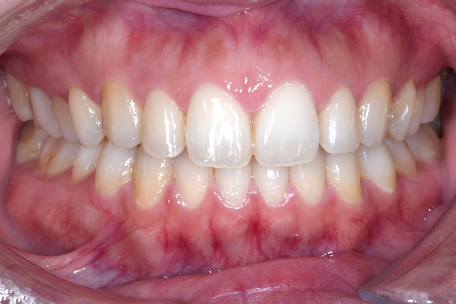 インビザライン術後写真