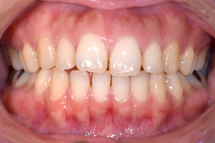 インビザライン術前写真