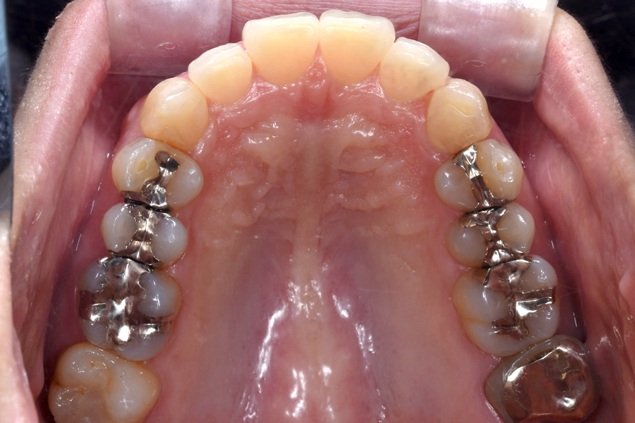 インビザライン術後写真