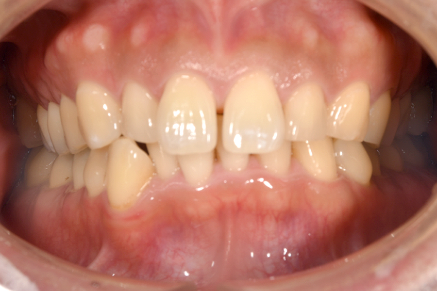 インビザライン術前写真