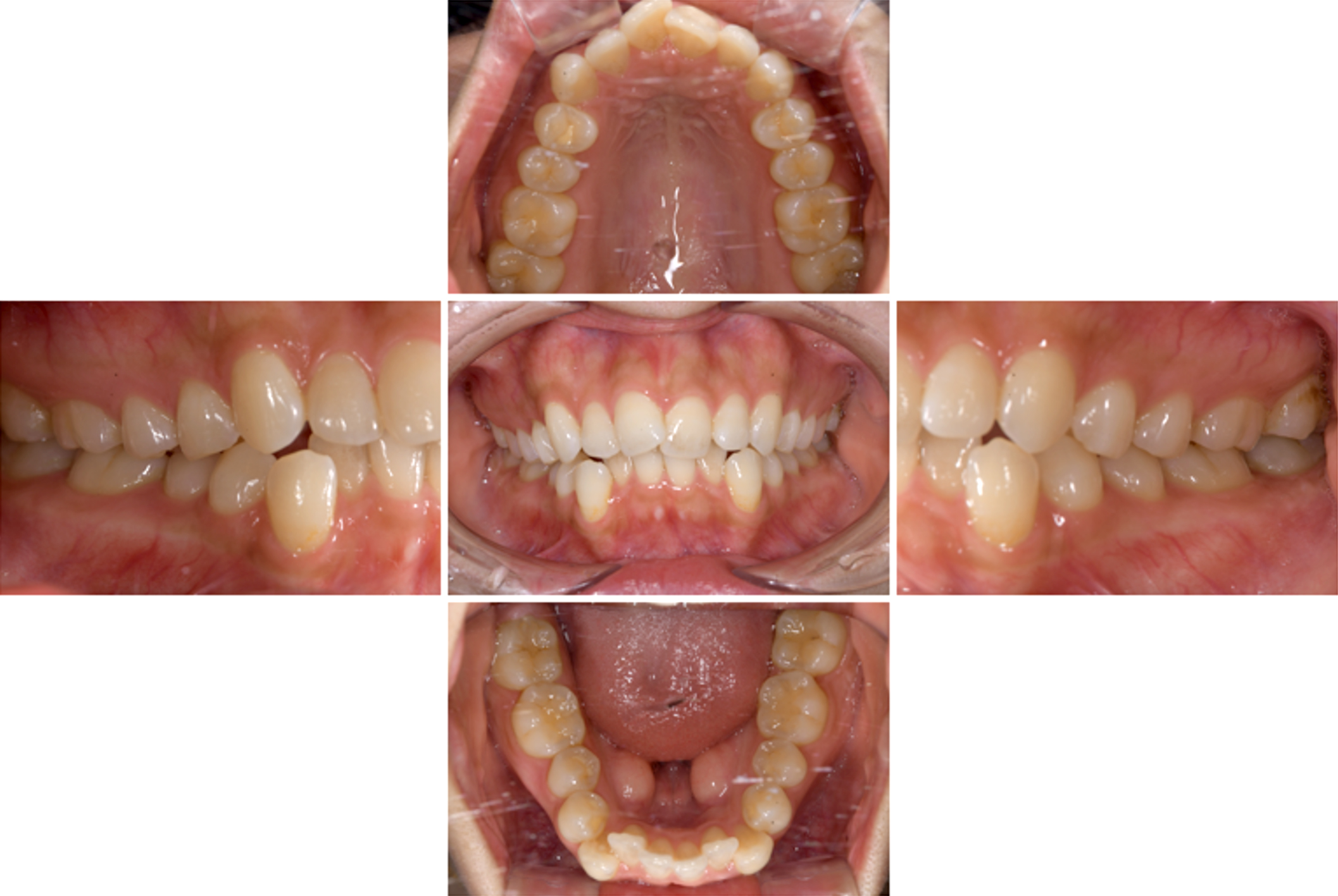 インビザライン術前写真