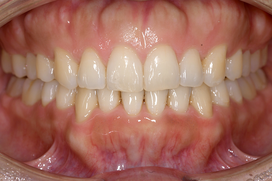 インビザライン術後写真