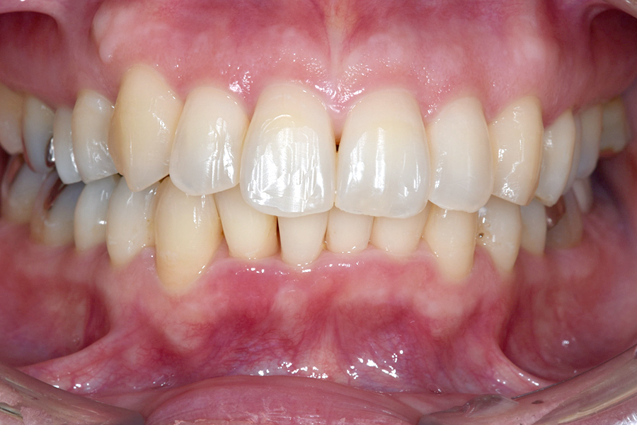 インビザライン術後写真