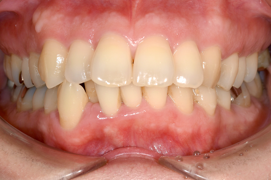 インビザライン術前写真