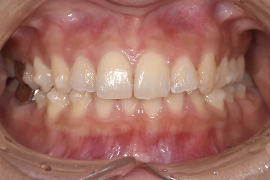 ホワイトニング術前写真