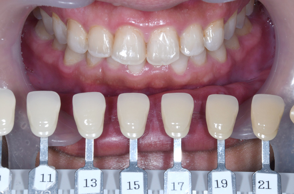 ホワイトニング術前写真