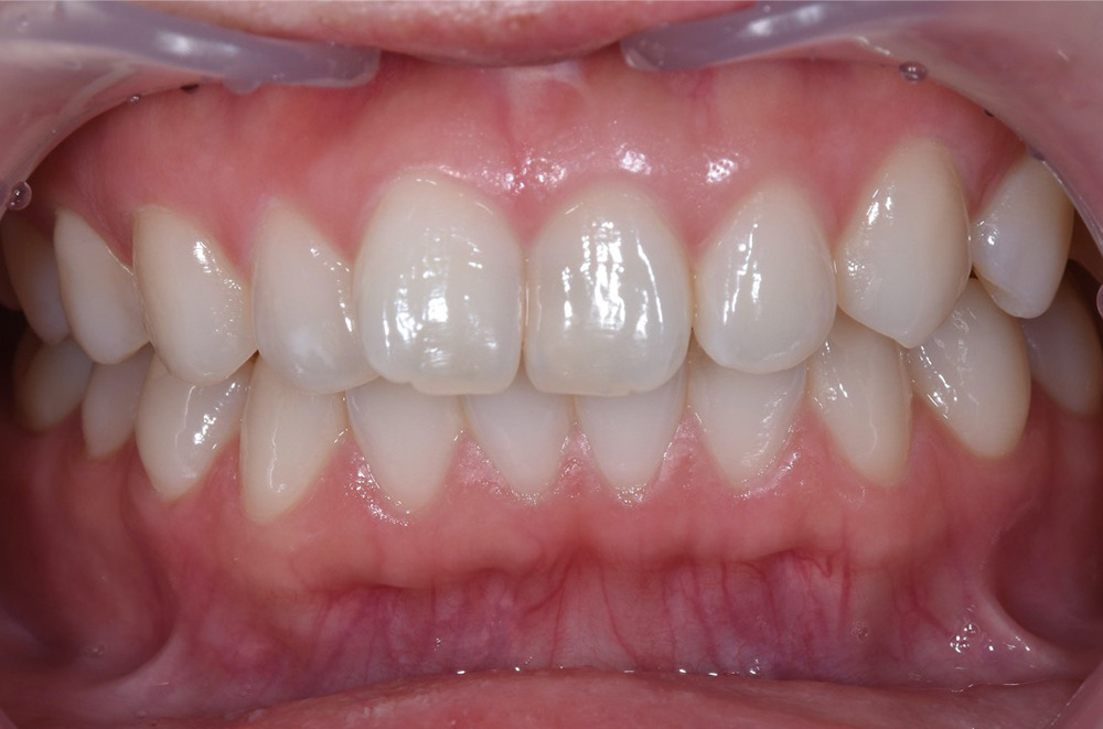 ホワイトニング術前写真