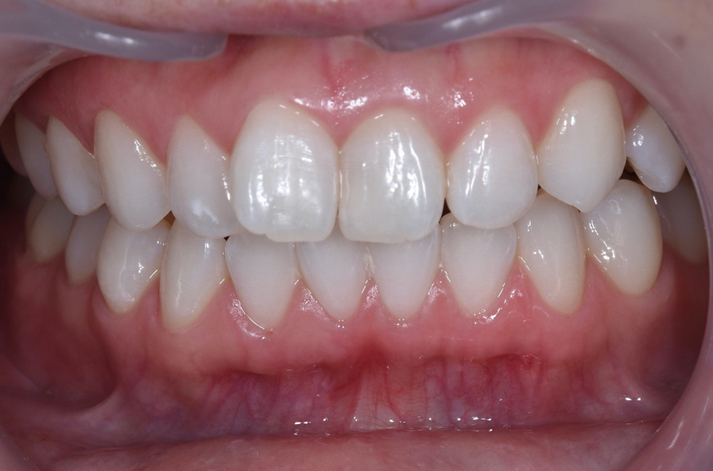 ホワイトニング術後写真