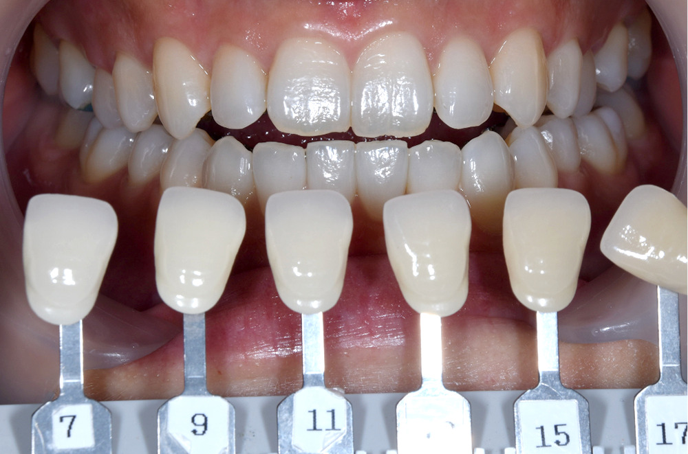 ホワイトニング術前写真