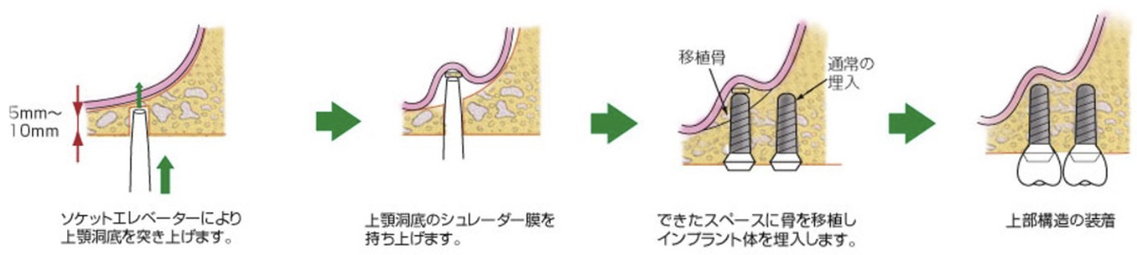 骨が足りない場合の追加の手術（ソケットリフト）
