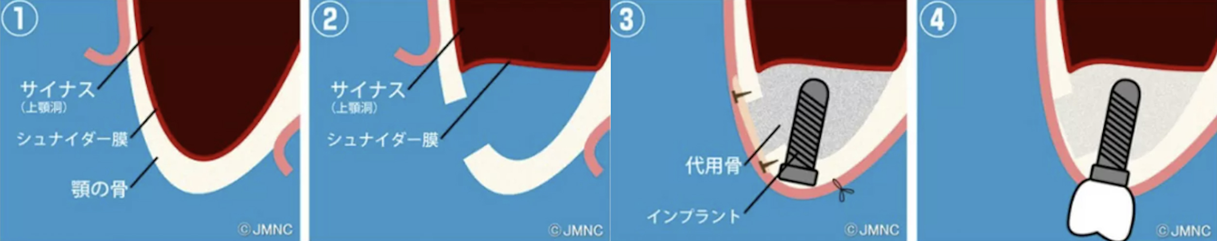 骨が足りない場合の追加の手術（ソケットリフト）